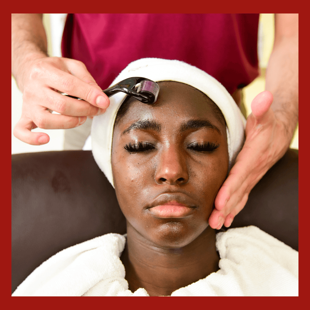 FACIAL SKIN NEEDLING ( with combination of PEELS )